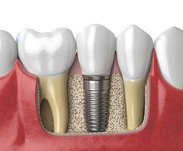 a 3D illustration of a dental implant in the jawbone