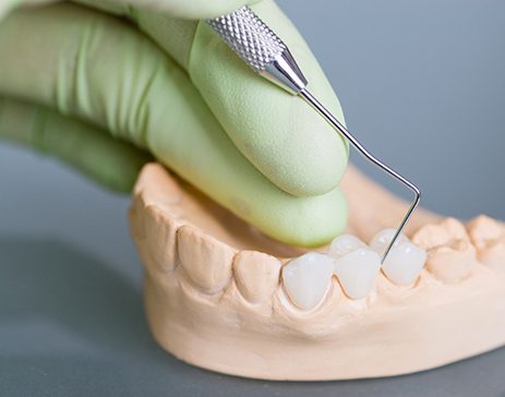 A dentist working on a dental bridge