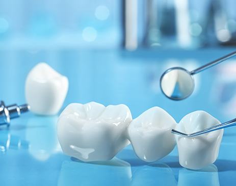 A dental bridge and implant parts set against a blue background