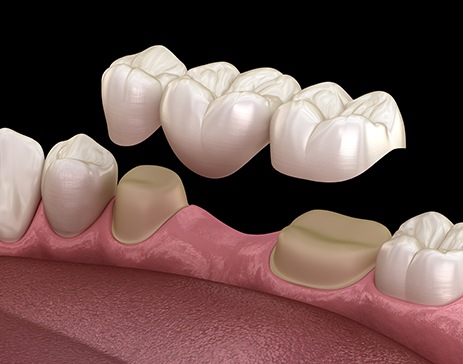 A 3D illustration of a dental bridge