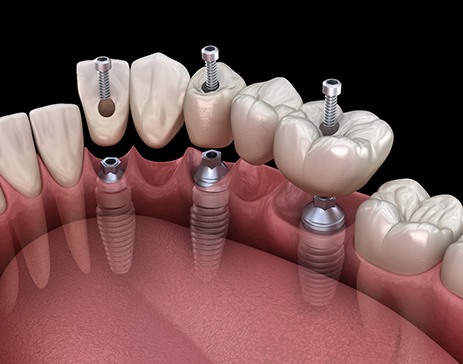 A 3D illustration of an implant bridge