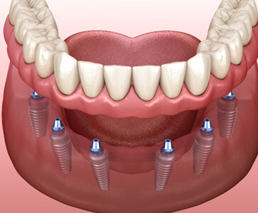 3D render of an implant denture