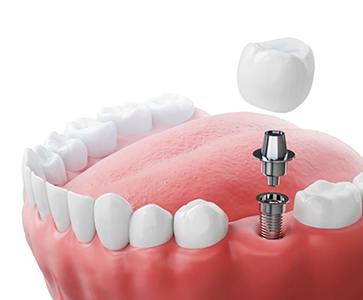 Illustration of dental implant being placed between natural teeth