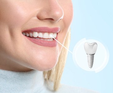 A graphic pointing out a woman’s dental implant