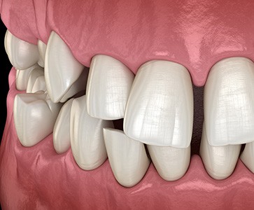 Illustration of gapped teeth