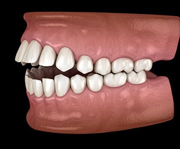 Illustration of an open bite