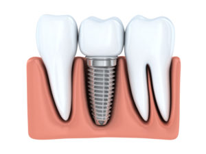 cross section of dental implant