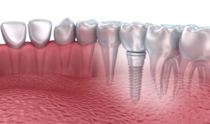 Considering dental implants in Larchmont Village but not sure what the process to receive them is like? Dr. Benjamin Geller gives you the scoop here. 