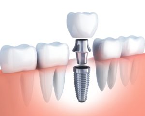 Image of a dental implant.