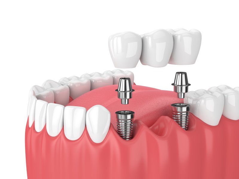 Illustration of dental bridge secured by implants