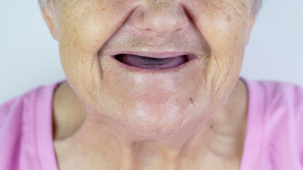 A woman experiencing facial sagging due to missing teeth.